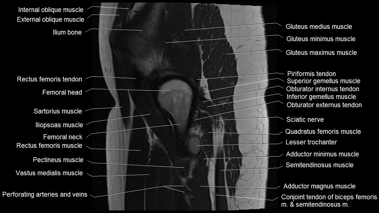 Hip sagittal cross sectional anatomy image 16.webp